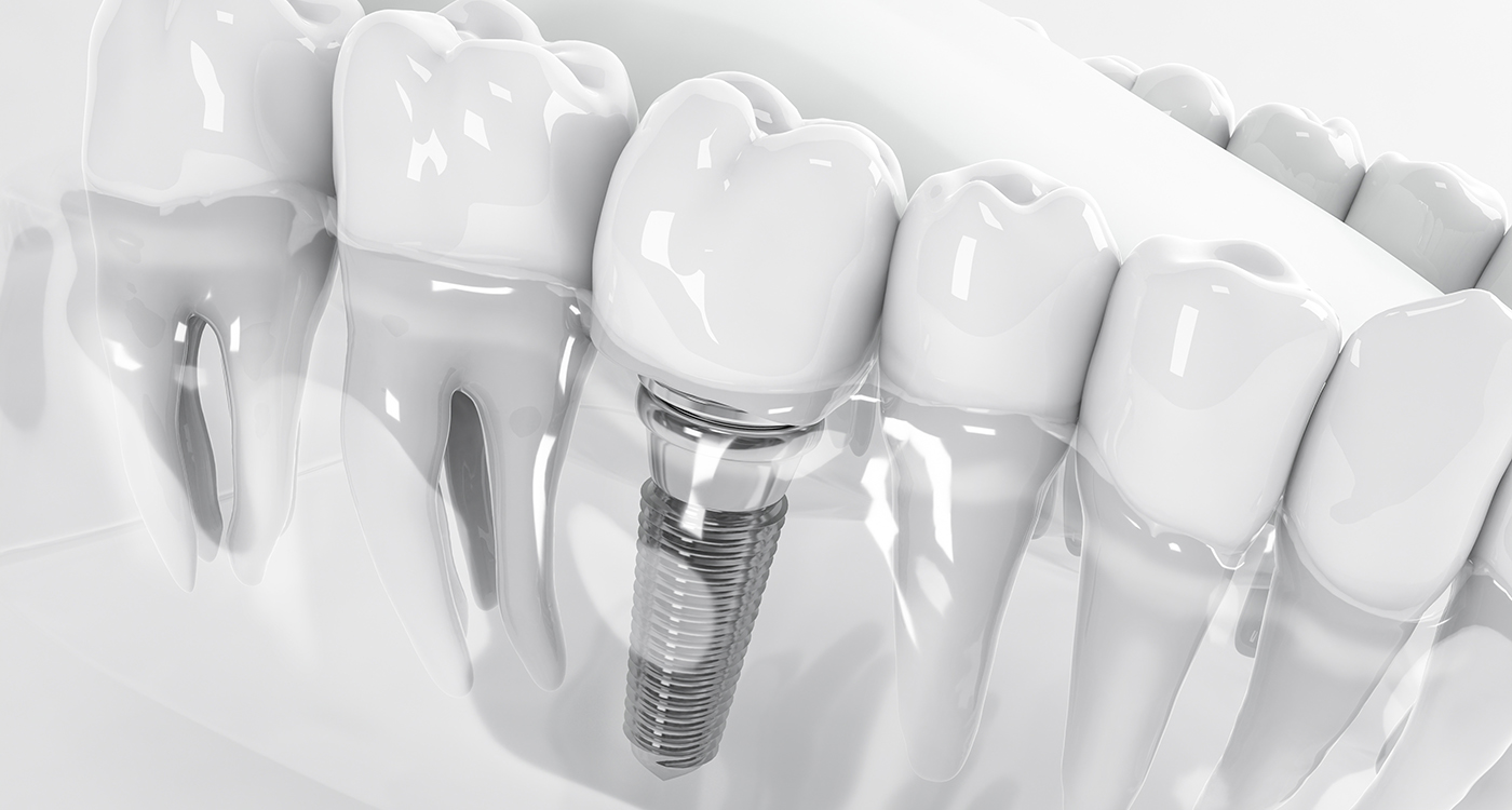 Detail of a false tooth implant fixed in the jaw benefits of hybridge dental implants