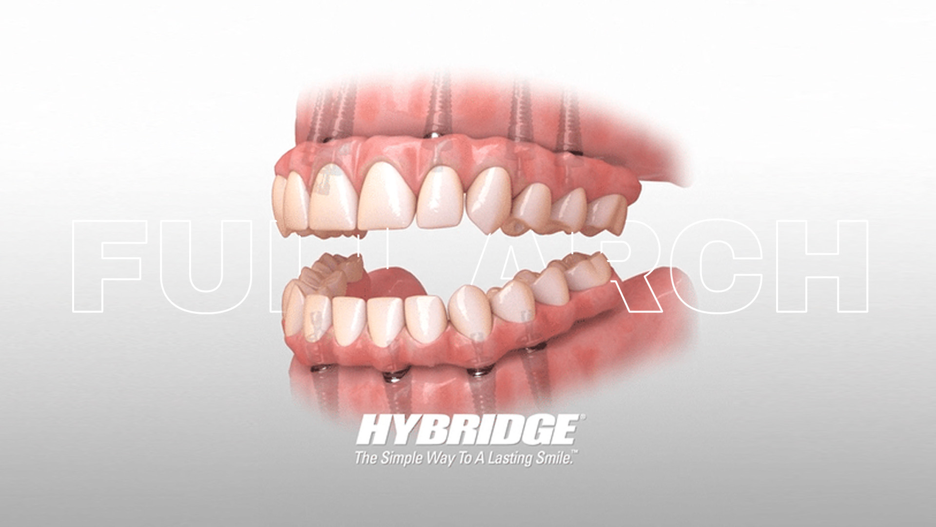 Regain Your Smile with Hybridge Full Arch Dental Implants