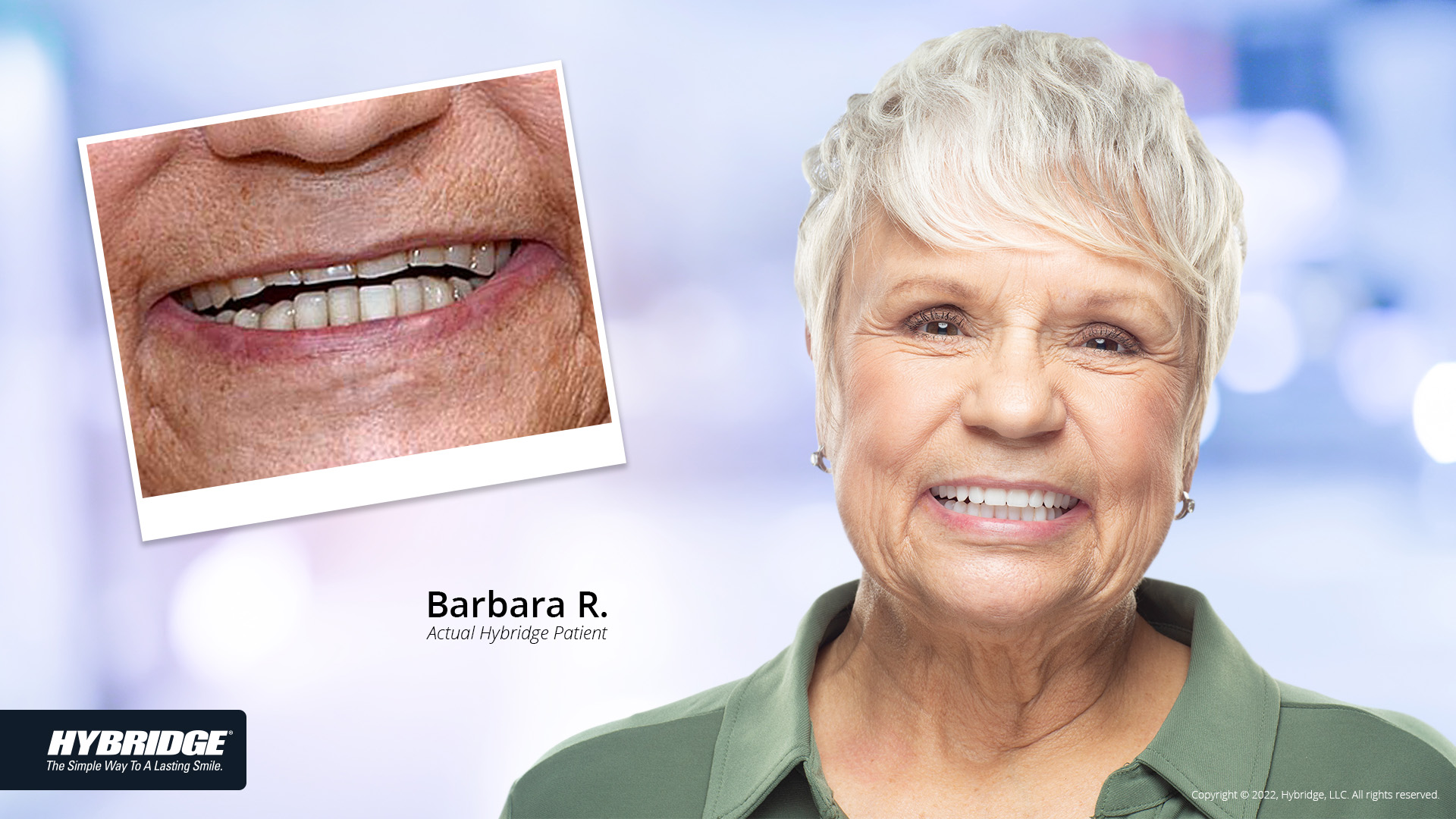 Hybridge Dental Implants before and after with Barbara