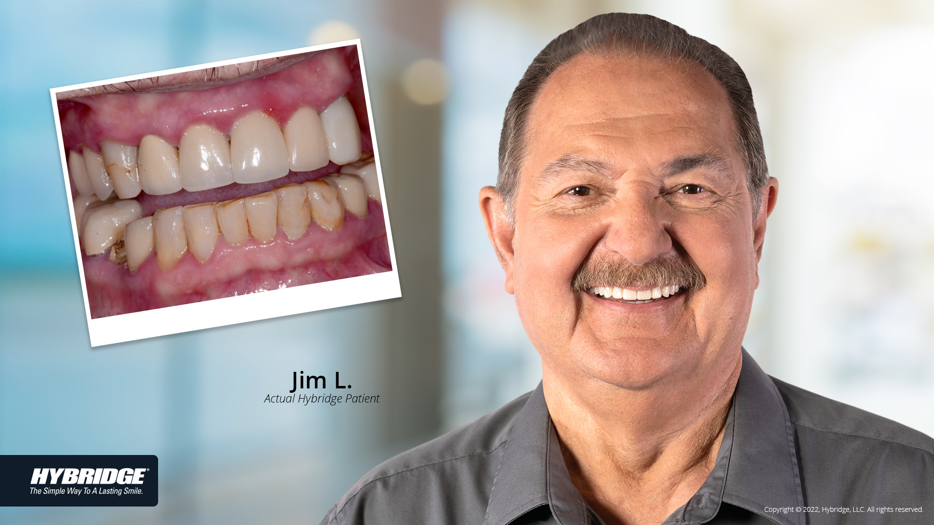 Jim before and after Hybridge Dental Implants